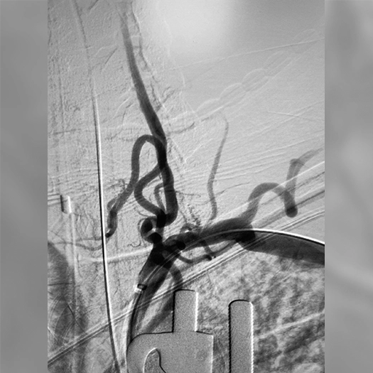 angiogram of an aneurysm