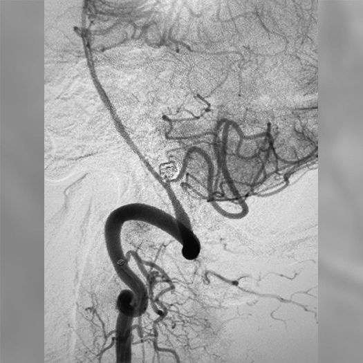angiogram of an aneurysm
