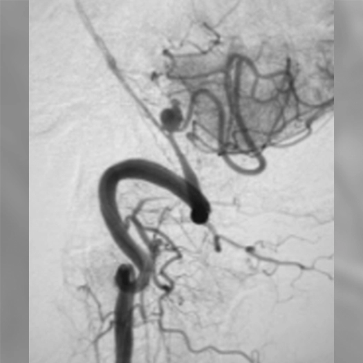 angiogram of an aneurysm