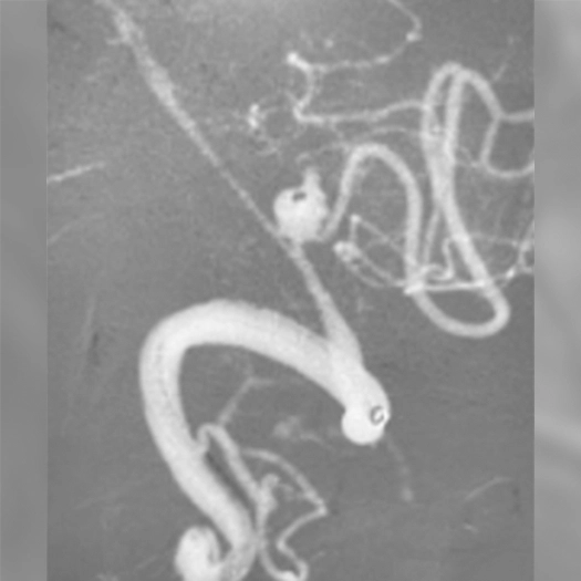 angiogram of a coil deployed to an aneurysm