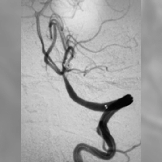Angiogram of coil deployed to an auerysm