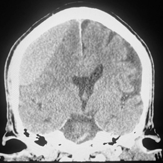 Initial CT Scan of an MMA