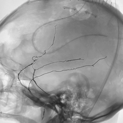 Embolization angiogram of skull