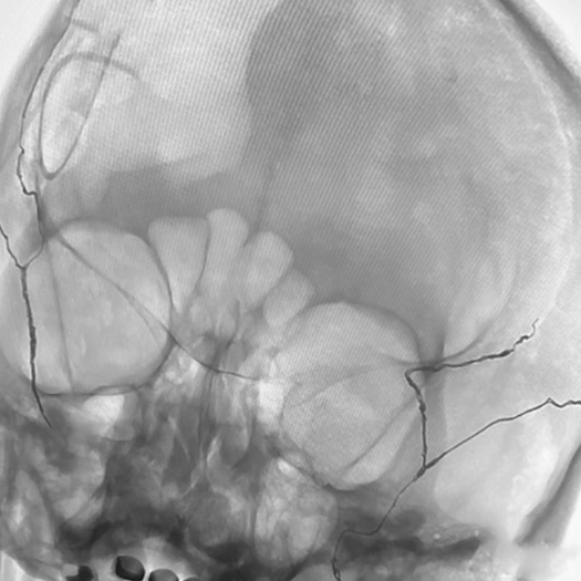 Embolization angiogram of skull