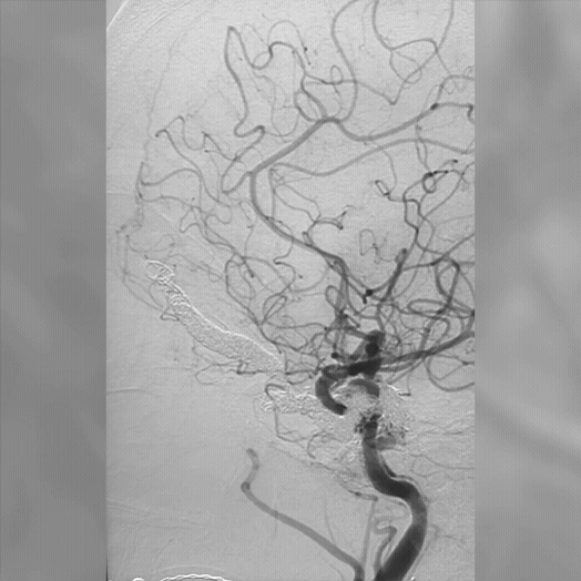 Embolization of fistula angiogram