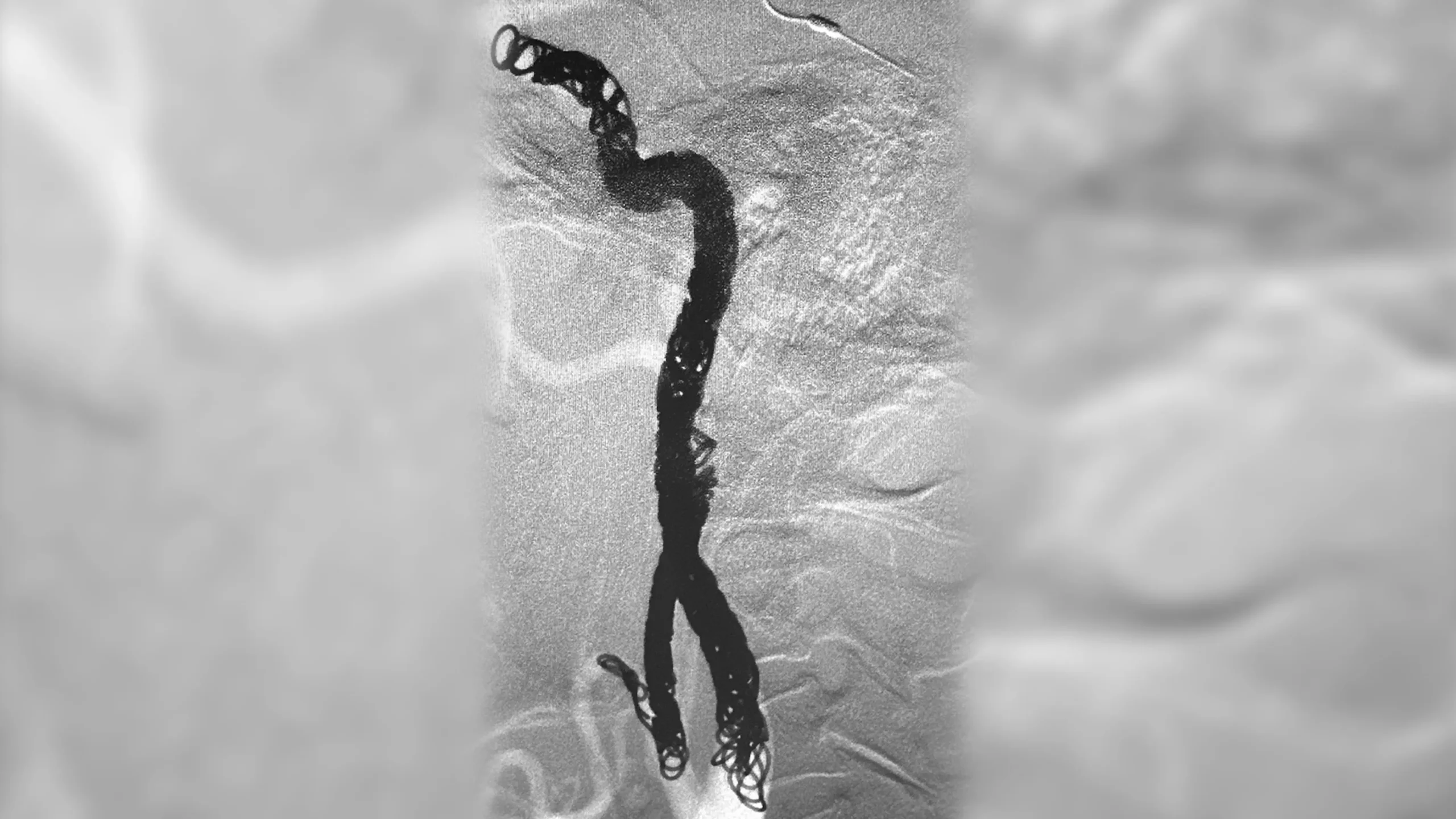 angiogram of embolization coils placed in a vessel