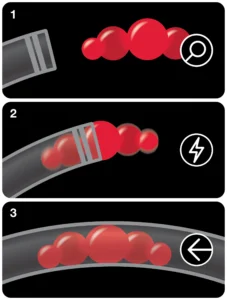 3Three-step illustration showing a catheter approaching a cluster of red particles in a vessel (step 1), particles being captured within the catheter (step 2), and particles contained inside the vessel lumen after collection (step 3)