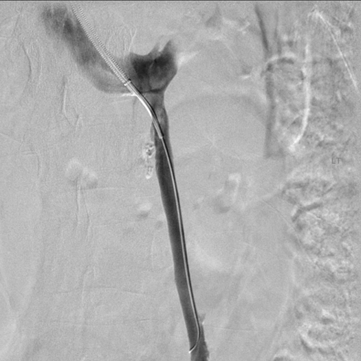 angiogram of a blood vessel
