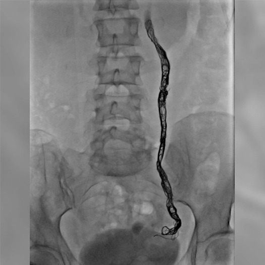 Angiogram of embolization coil place in the body