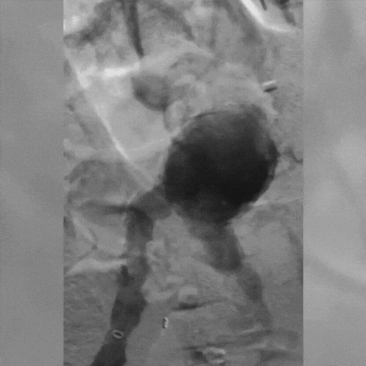 angiogram of vessel in the body