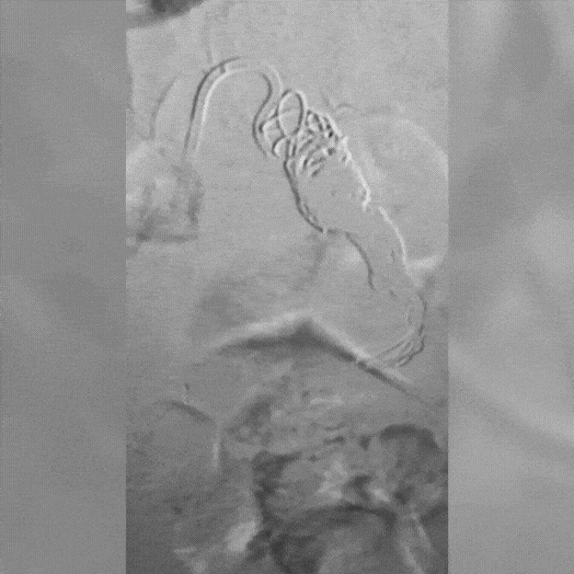 angiogram of embolization coil placed in the body