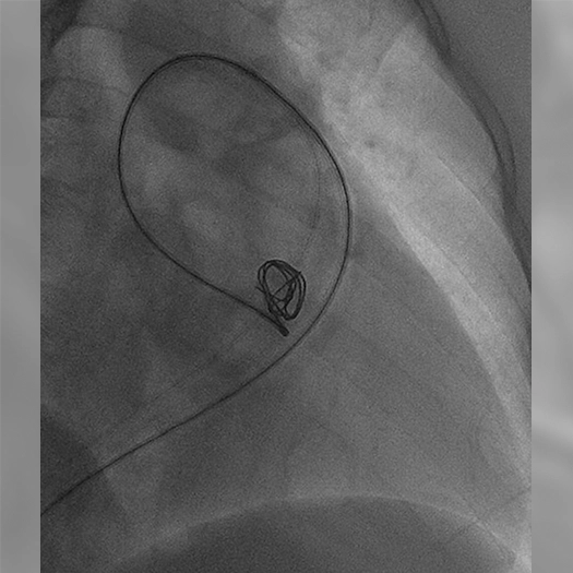 angiogram of embolization coils being deployed within the body