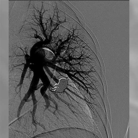 angiogram of Embolization coils placed into a body