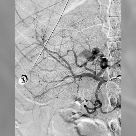 Angiogram of blood vessels