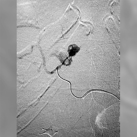 Angiogram of embolization coil being deployeed in blood vessels
