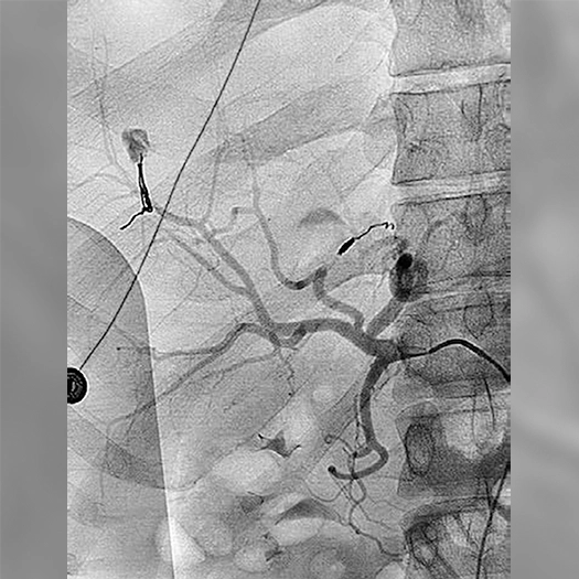 Angiogram of embolization coils deployed in blood vessels