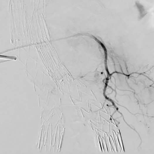 angiogram of blood vessels