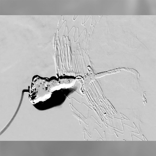 Angiogram of embolization coils deployed in a blood vessel