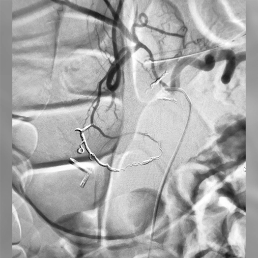 Angiogram of Embolization coils in a vessel