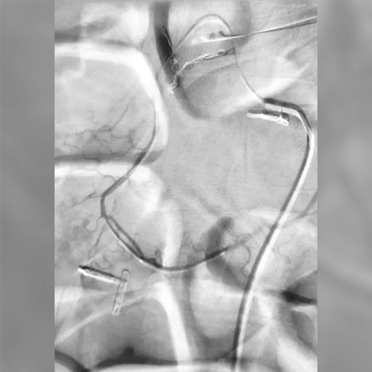 Angiogram of blood vessel