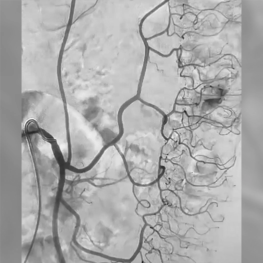 Angiogram of blood vessels