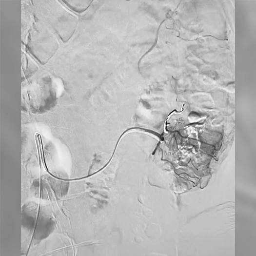 angiogram of embolization coil placed in vessels