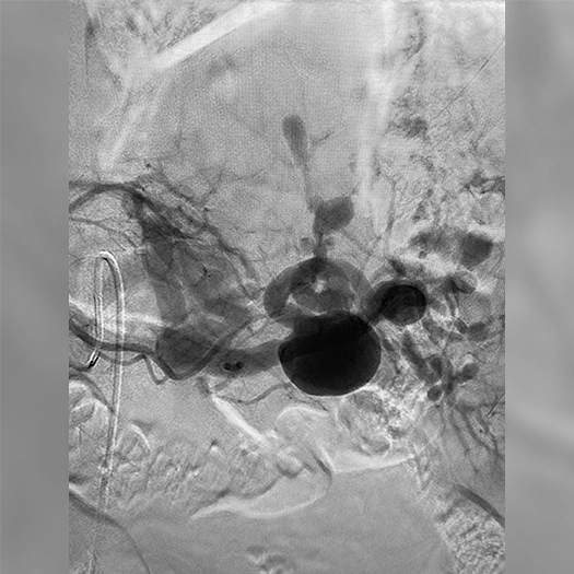 Angiogram of an aneurysm