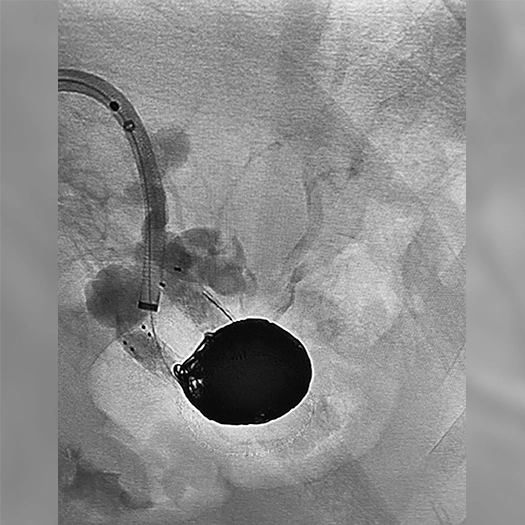 angiogram of Embolization Coils deployed in a vessel