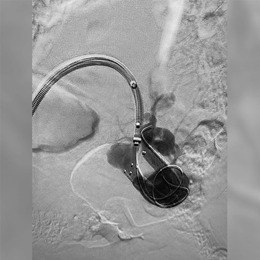 angiogram of an embolization coil being deployed in an aneurysm