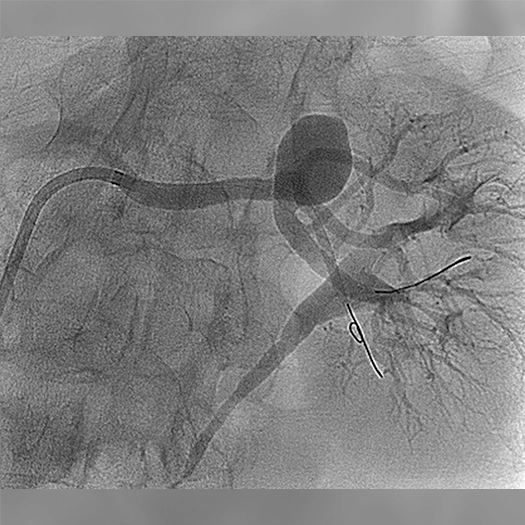 angiogram of an aneurysm