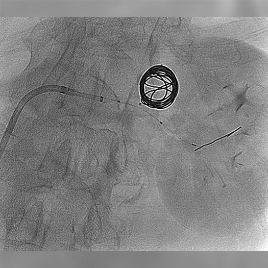 angiogram of an embolization coil being deployed in an aneurysm