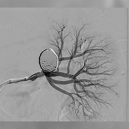 angiogram of an aneurysm filled with an embolization coil