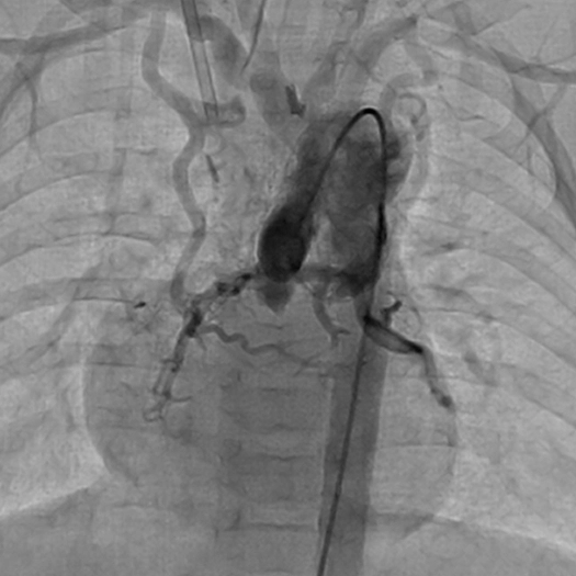 Angiogram of blood vessels