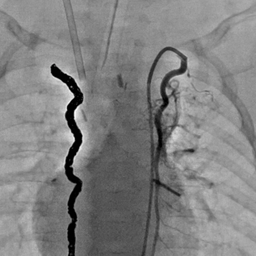 Angiogram of embolization coils being deployed in vessels