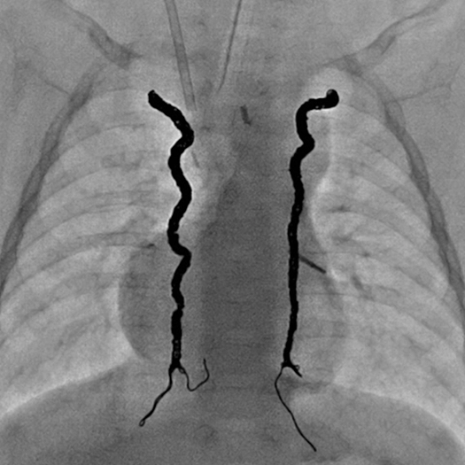 Angiogram of embolization coils deployed in the body