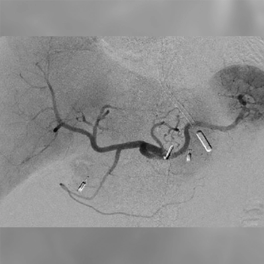 angiogram of blood vessel