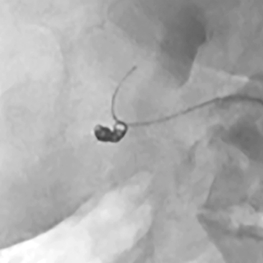 Angiogram of an aneurysm
