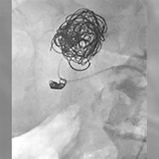 angiogram of an embolization coil being deployed into an aneurysm