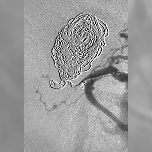 angiogram of an embolization coil place in an aneurysm