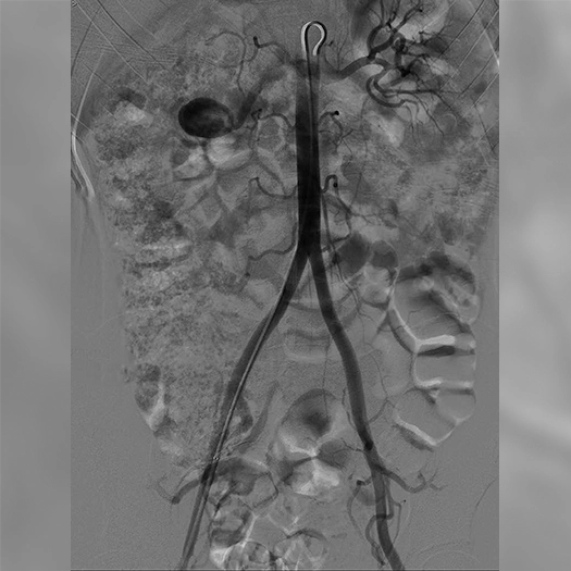 angiogram of blood vessel