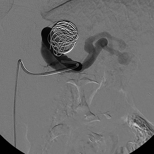 angiogram of embolization coil being deployed in vessel