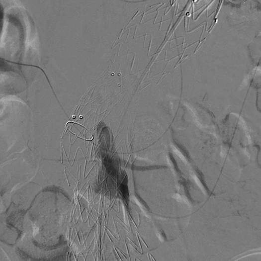 angiogram of blood vessel in the body