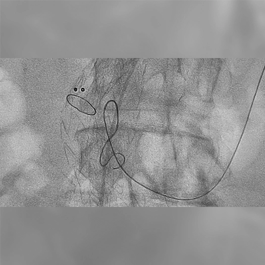 angiogram of Embolization Coils being deployed into the body