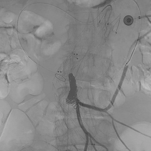 angiogram of Embolization Coils deployed into the body