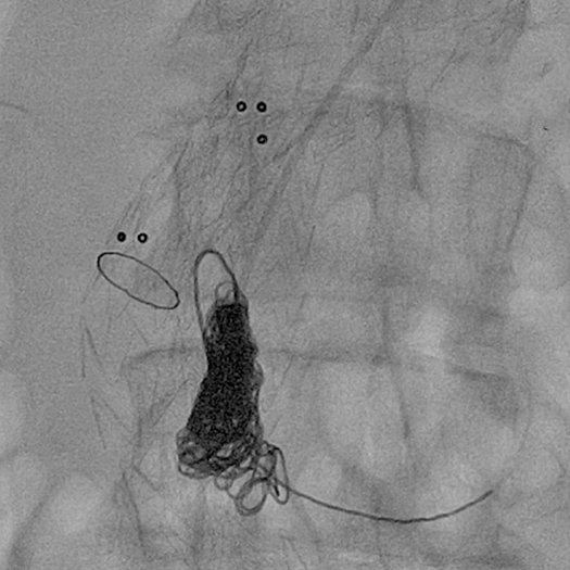 angiogram of Embolization Coils being deployed into the body
