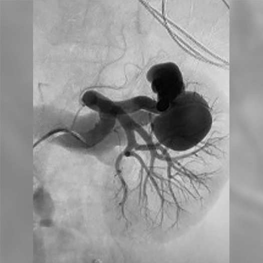 angiogram of blood vessel