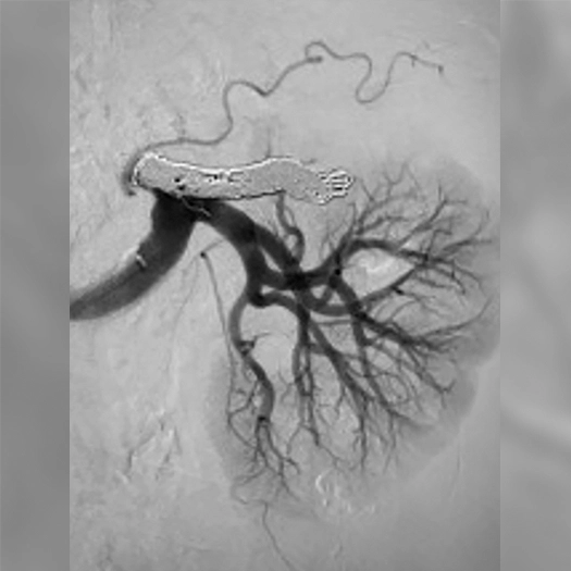 angiogram of Embolization coils placed into a body