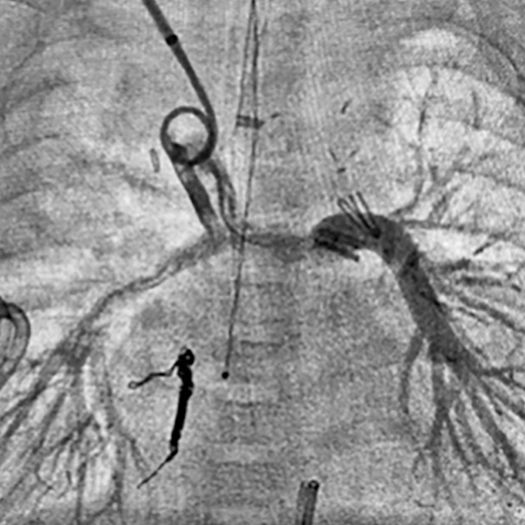 angiogram of blood vessels