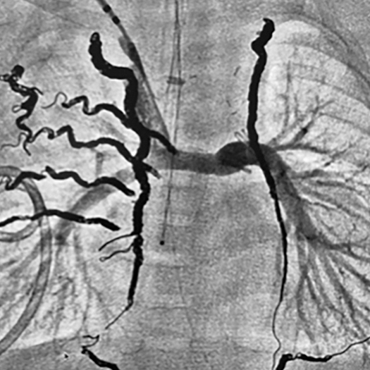 angiogram of embolization coils deployed in blood vessels