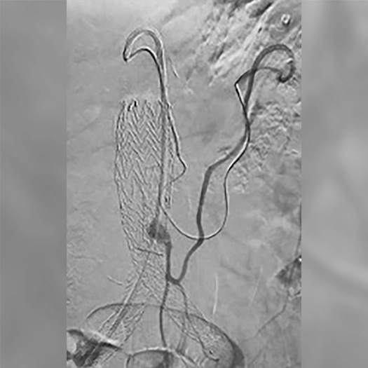 angiogram of vessel in the body